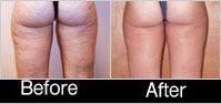 tights-before-after